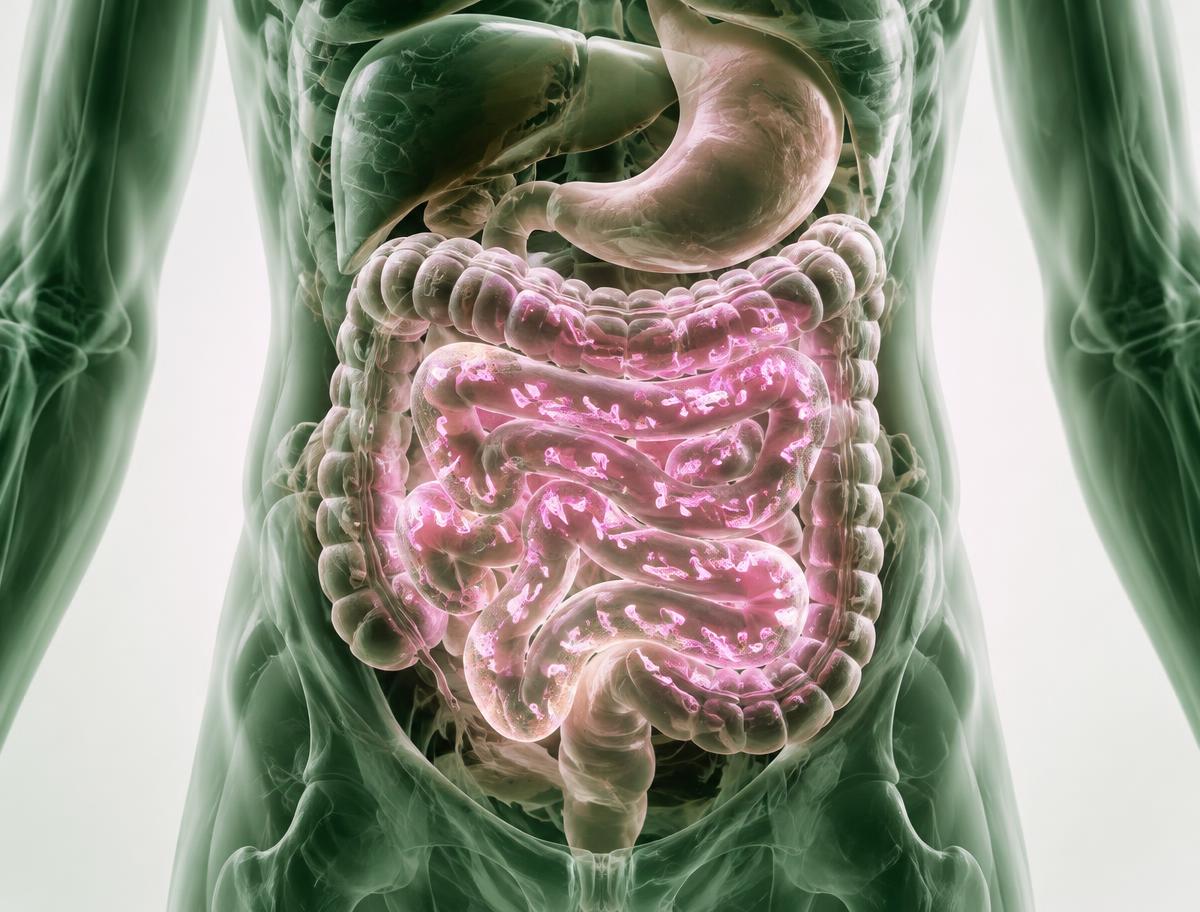 Representación del intestino delgado con crecimiento bacteriano asociado al SIBO